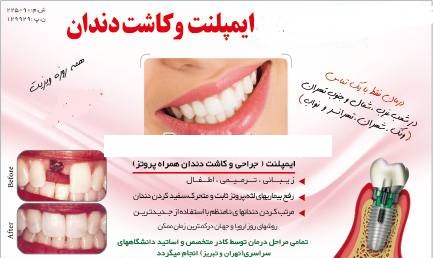 آموزش ایمپلنتهای دندانی