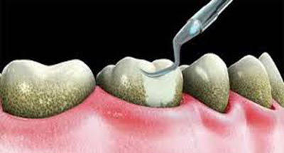  مراحل جرمگیری دندان، حساسیت دندانها