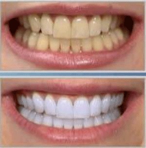 سفید کردن دندان به روش طبیعی