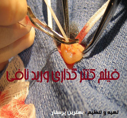 کتترگذاری ورید نافی(Umbilical Vascular Catheterization)+فیلم