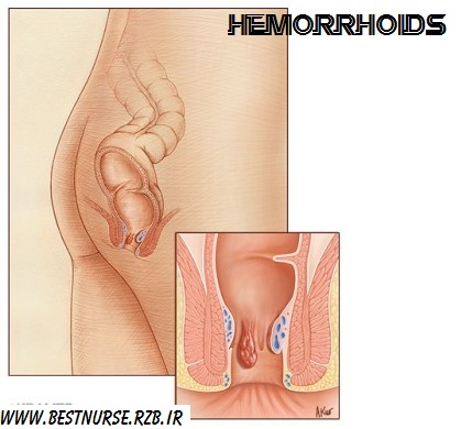 هموروئید (Hemorrhoids)+مراقبت های پرستاری