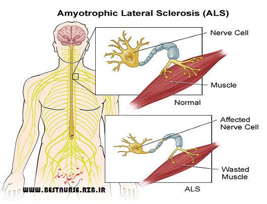 اسکلروز جانبی آمیوتروفیک( Amyotrophic lateral sclerosis)