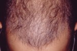  علل اصلی ریزش موها و راههای تشخیص و درمان 