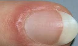 علت شکستگی پوست حاشیه ناخن و راه درمان آن