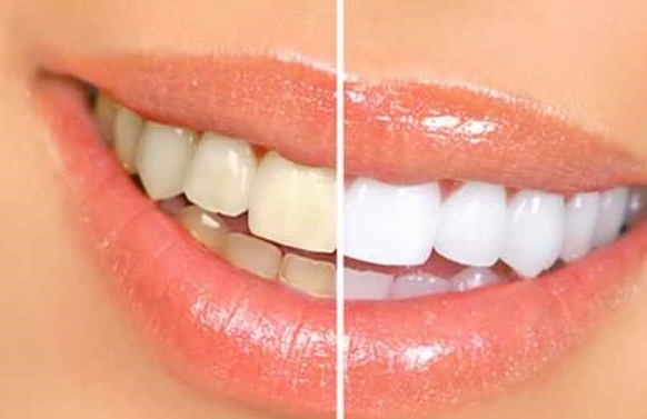علت زرد شدن دندان‌ ها چیست؟