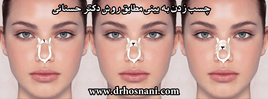 تصویر: https://rozup.ir/up/rhinoplasty-info/nose-taping-method.png