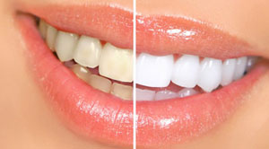 سفید کردن دندان در منزل.jpg (300×166)