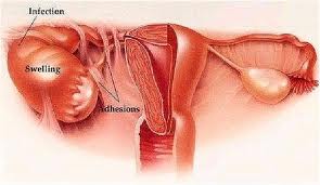 علل و درمان خشکی واژن