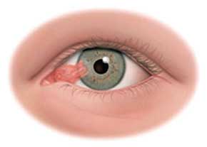 درمان ناخنک چشم(طب سنتی)