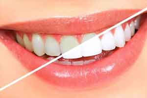 فرمول سفید کردن دندان در خانه
