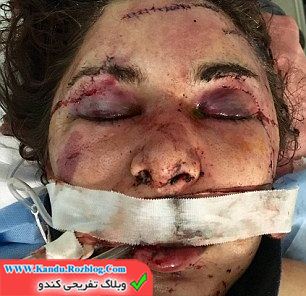 ضرب و شتم دخترجوان توسط نامزدش در روز تولدش+عکس
