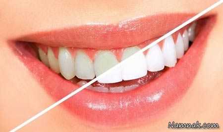 “سفید شدن دندان” در1ساعت ، ارزان ولی ماندگار