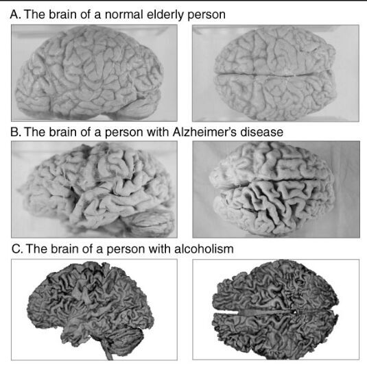 عکس مغز انسان ساده،انسان آلزایمری و انسان الکلی