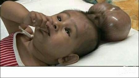 کودکی با دو سر بنام توفاجال از بیماری نادر ژنتیکی رنج می برد که گفته می شود از هر 40 تا 45 هزار کودک یک 