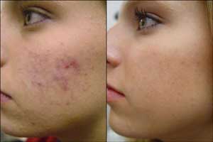 انواع لک های پوستی درمان آنها