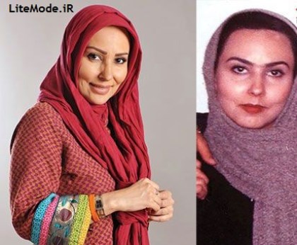 عکس قبل و بعد عمل زیبایی