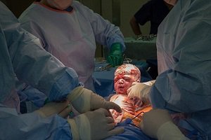 بریدن صورت نوزاد در حین عمل سزارین +عکس