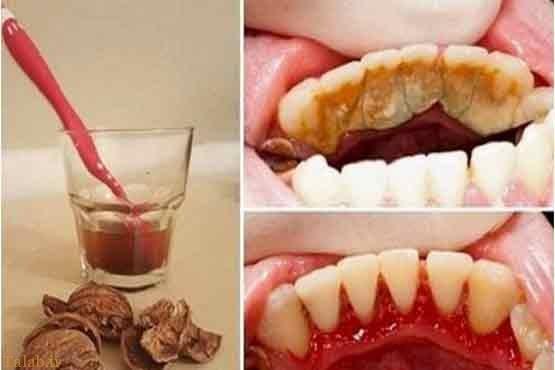 جرم گیری دندان ها با یک روش طبیعی