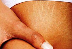 ۵ روش طبیعی و آسان برای خلاصی از ترک‌های پوست