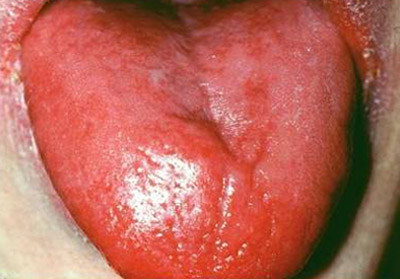 بیماری التهاب زبان و درمان آن