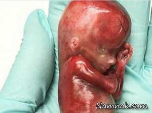 عکس جنین سقط شده 19 هفته ای در دستان پزشک