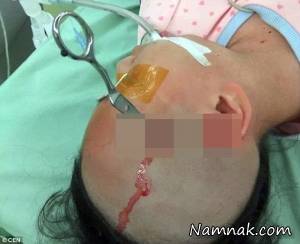 پدر بی رحم با قیچی سر دخترش را شکافت + تصاویر