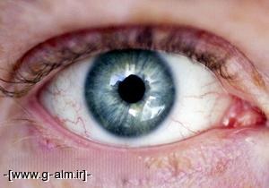  تشخیص آلزایمر با نگاه کردن به چشم‌!