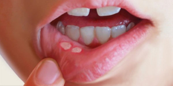 درمان آفت دهان با روش خانگی و گیاهی