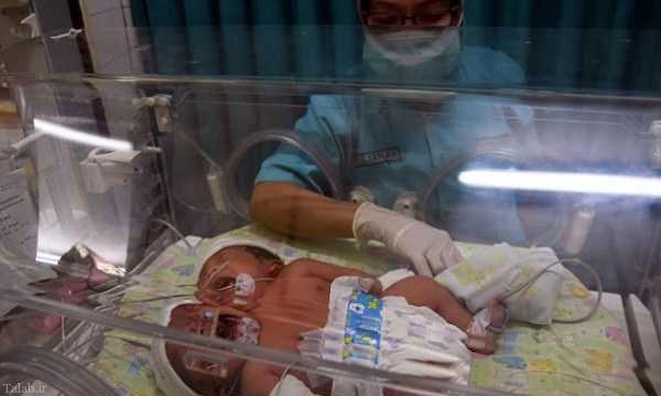 بدنیا آمدن نوزادان به هم چسبیده در اندونزی