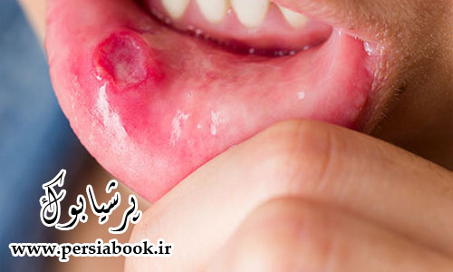 درمان آفت دهان با 15 روش خانگی و گیاهی