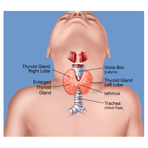 بیماری التهاب‌ تيروييد (تيروييديت‌)  thyroiditis