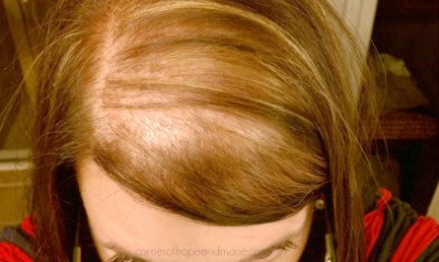 علت ریزش مو,عوامل ریزش مو