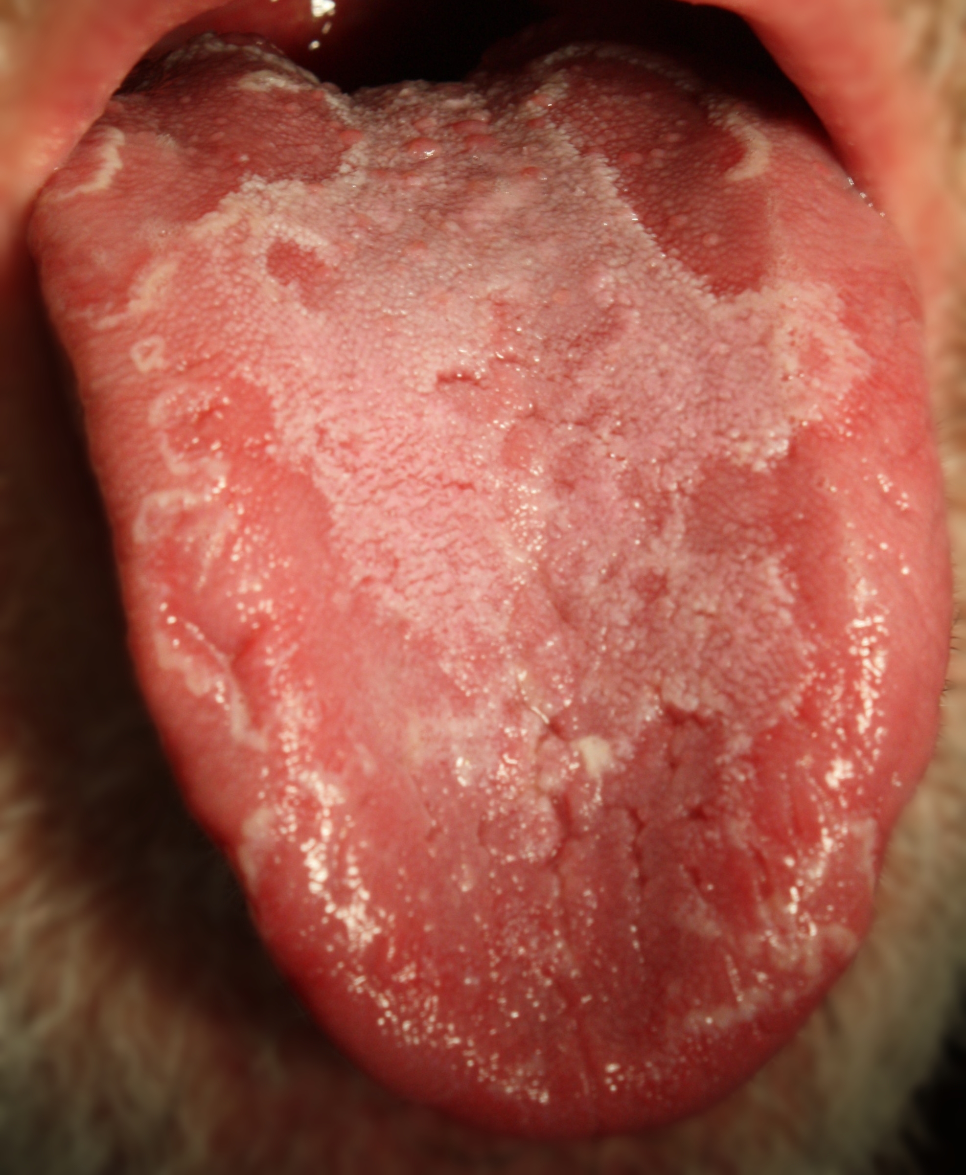 شناخت بیماری التهاب‌ زبان‌ (گلوسيت‌):tongue inflammation