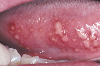 التهاب‌ زبان‌ (گلوسيت‌) tongue inflammation