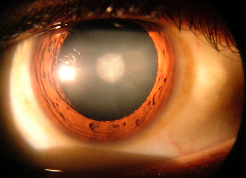 اشنایی با بیماری آب‌ مرواريد: cataract