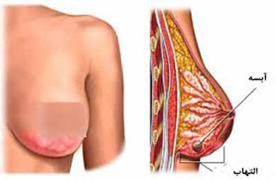 آبسه‌ پستان‌ breast abscess