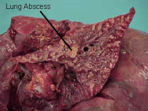 آبسه ریه (به انگلیسی: Lung abscess)
