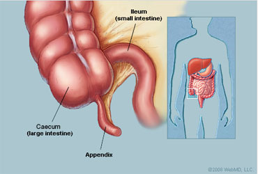 آپاندیسیت (به انگلیسی: Appendicitis)