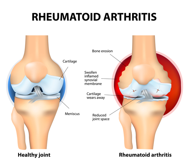 اشنایی با بیماری آرتیت روماتویید :Rheumatoid arthritis