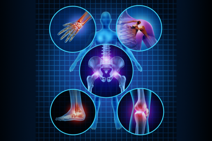 بیماری آرتریت عفونی:Arthritis و راه علاج ان