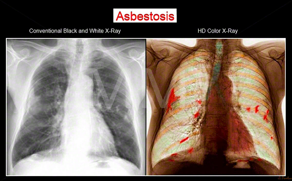 آزبستوز (به انگلیسی: Asbestosis) 