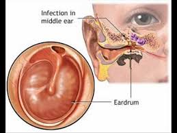 صلی‌ترین عامل ابتلا به عفونت گوش میانی، اختلال عملکرد شیپور استاش است.