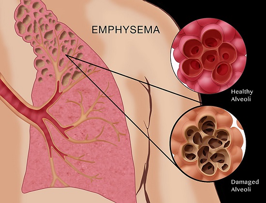 آمفيزم‌ : Emphysema (علل,پیشگیری,دارو  و در مان...