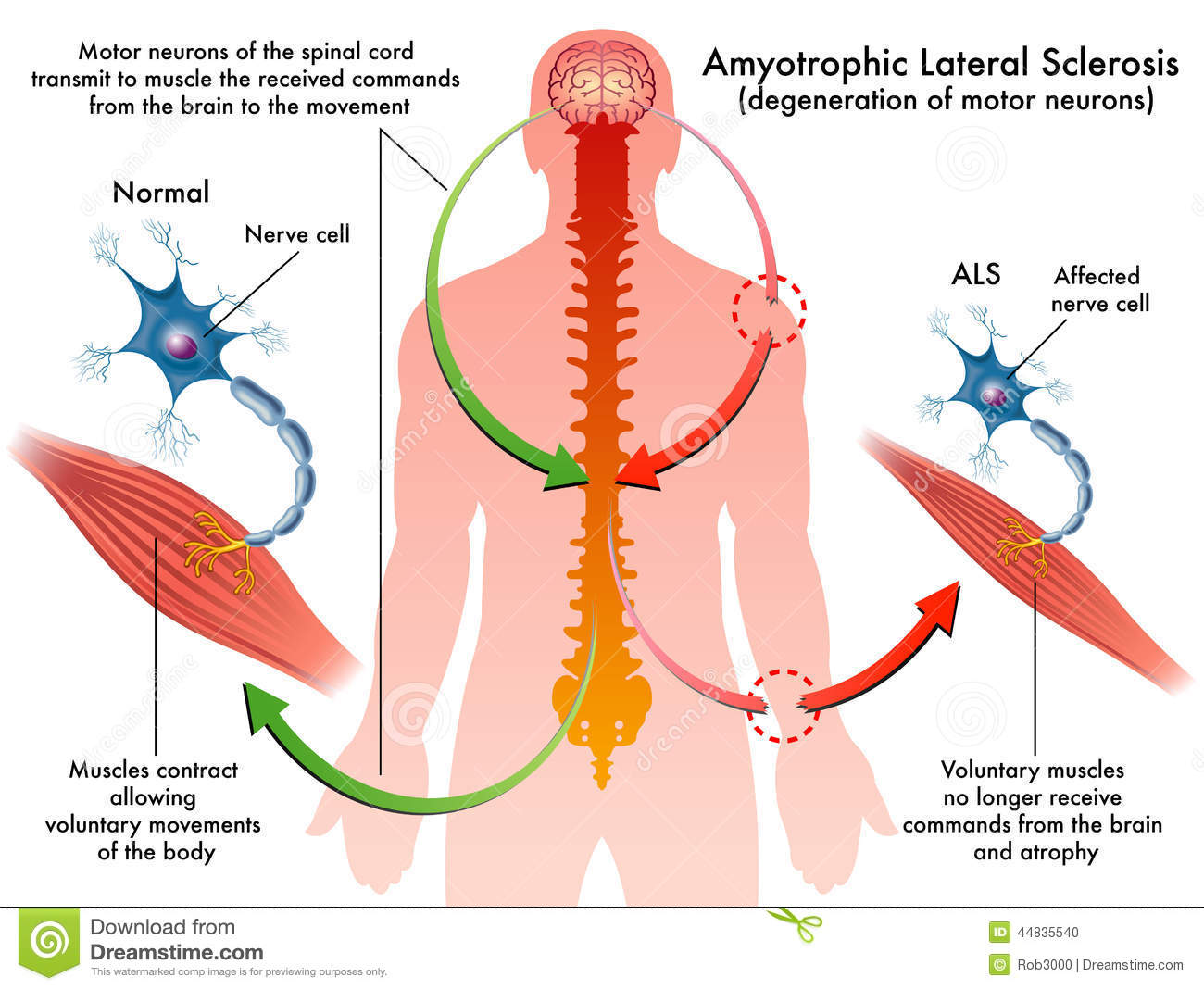  آميوتروفيك‌ لاترال‌ اسكلروز: Amyotrophic lateral sclerosis (ALS شرح بیماری,پیشگیری و ...