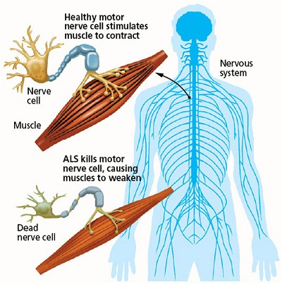 شایعترین بیماری نورون‌های حرکتی (MND) می‌باشد