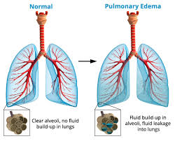 اِدِمِ ریه (به انگلیسی: Pulmonary edema) به معنی تجمع آب میان بافتی در ریه می‌باشد