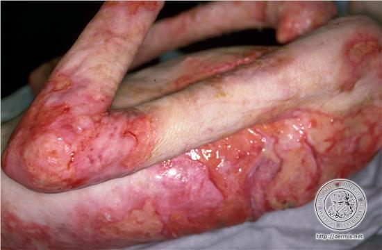 اریتم مولتی‌فرم (به انگلیسی: Erythema multiforme) یا قرمزشدگی چندشکل یک بیماری التهابی حاد پوست و غشاهای مخاطی است.