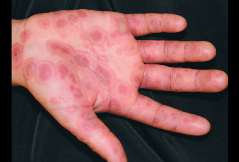اریتم مولتی‌فرم (به انگلیسی: Erythema multiforme) یا قرمزشدگی چندشکل یک بیماری التهابی حاد پوست و غشاهای مخاطی است.
