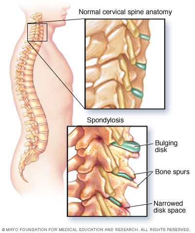 هرنوع بیماری تخریبی مهره‌های ستون فقرات را مُهراک[۱] یا اسپوندیلوز (به انگلیسی: Spondylosis) می‌گویند. مهراک از آسیب‌های غیر التهابی در ستون مهره‌های بدن است.