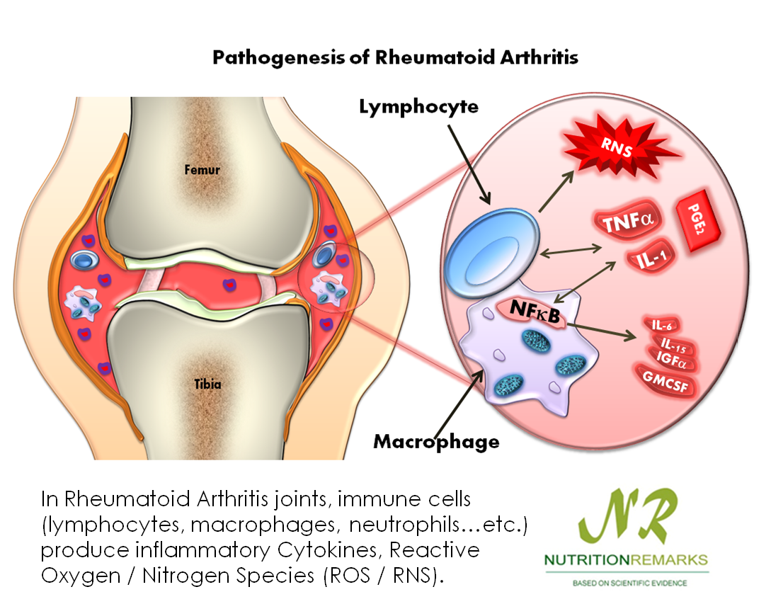 استئوآرتریت (به انگلیسی: Osteoarthritis) بیماری بسیار شایعی است که در تمام مناطق جغرافیایی دیده می‌شود